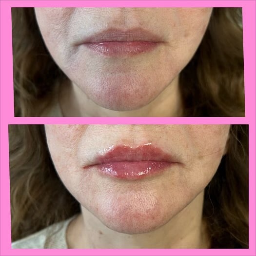 Before and After Image: Lip Filler - right-front-oblique