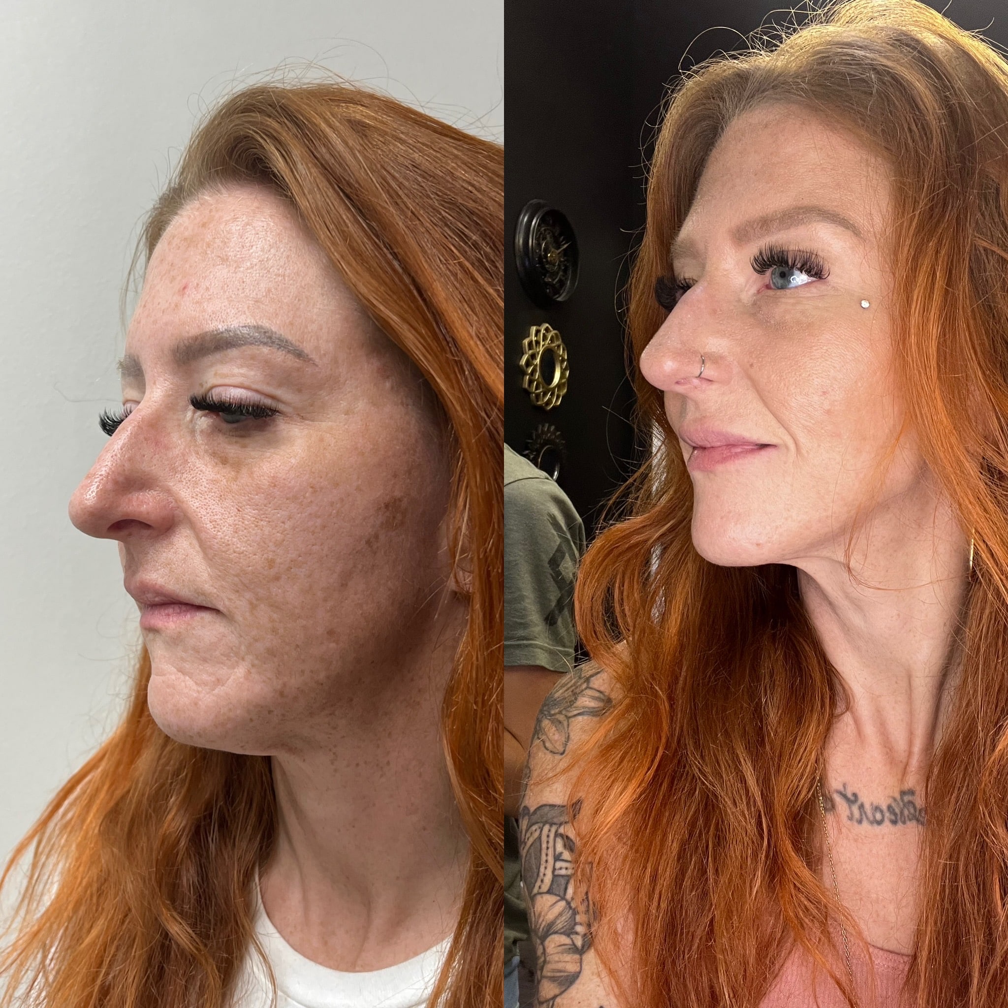 Before and After Image: Filler to cheek, undereye, and lips - left-front-oblique