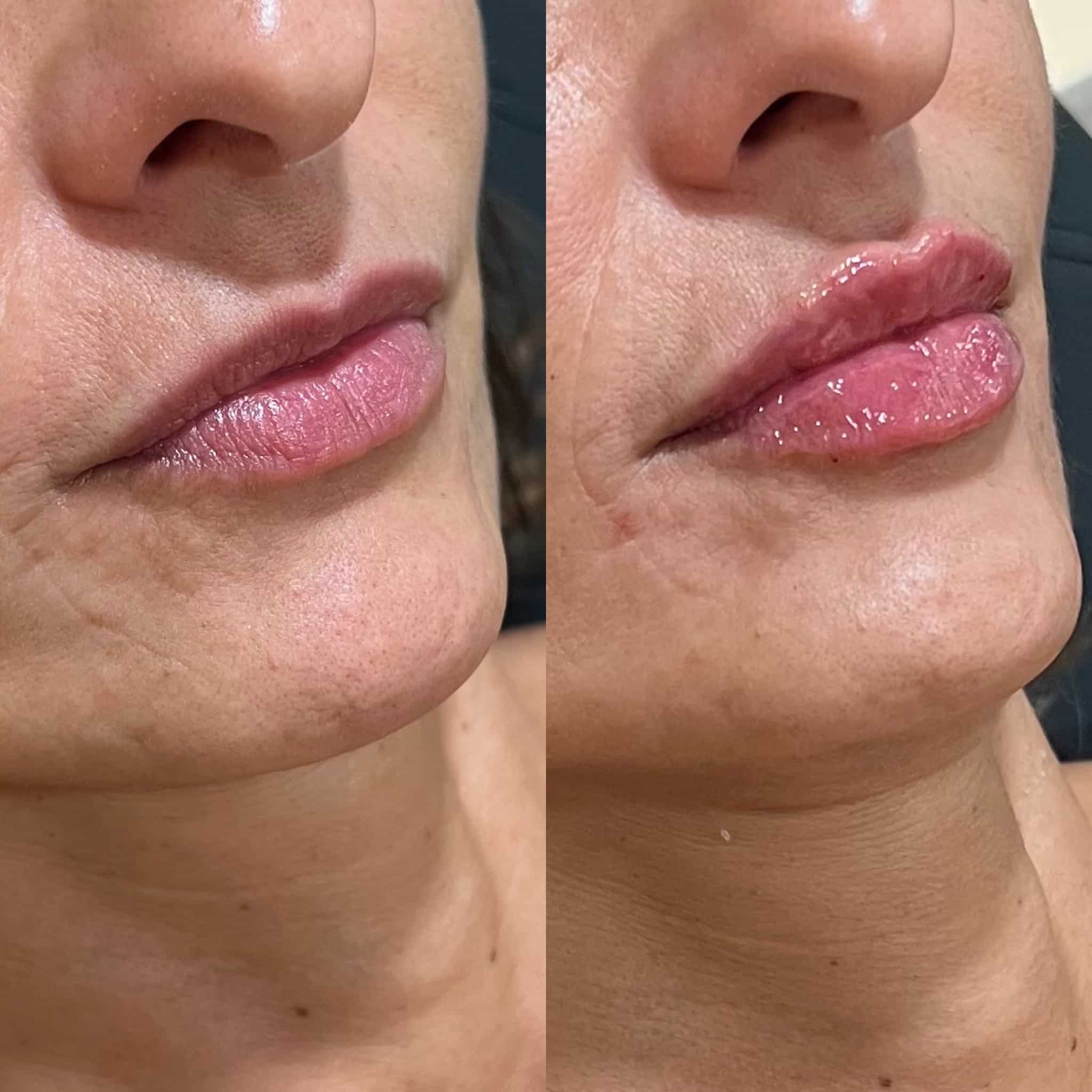 Before and After Image: Lip Filler - right-front-oblique