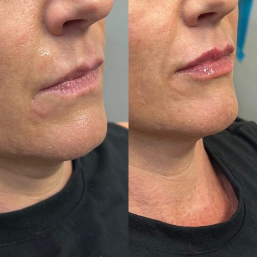 103299-LIP-FILLER-C11-image23