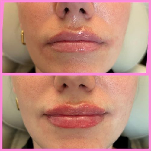 103299-LIP-FILLER-C2-image37