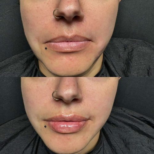 103299-LIP-FILLER-C3-image30