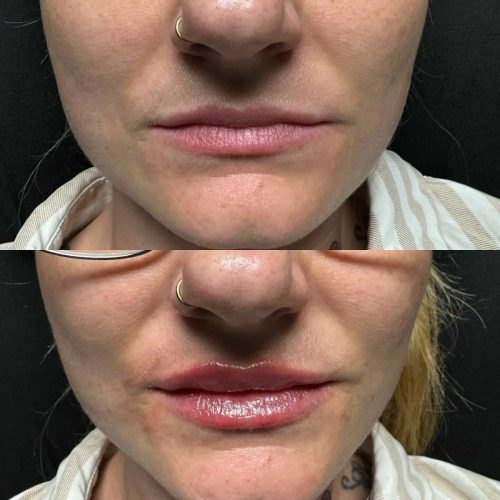 103299-LIP-FILLER-C4-image5