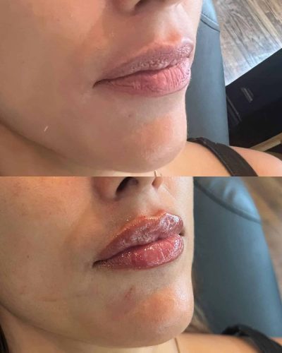 103299-LIP-FILLER-C6-image3