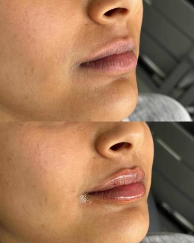 103299-LIP-FILLER-C7-image1