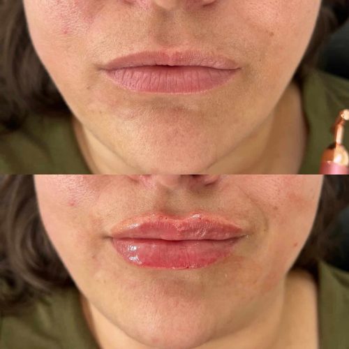 103299-LIP-FILLER-C8-image41