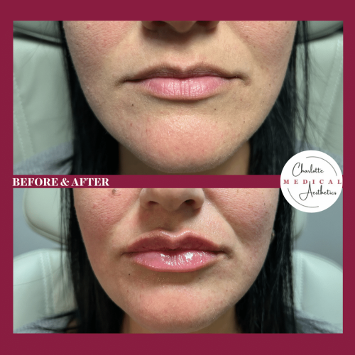 104840-Lip-Filler-c1-image1