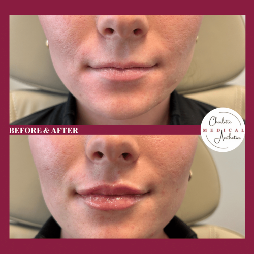 104840-Lip-Filler-c2-image6