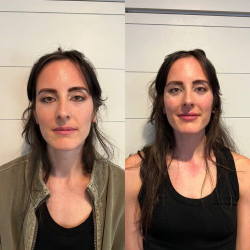 Cheek-and-Lip-Filler-c1-1