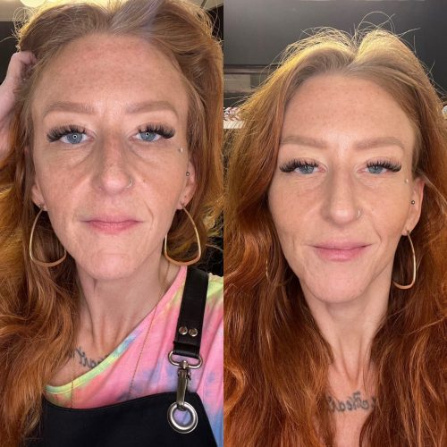 Filler-to-cheek-undereye-and-lips-c1-1