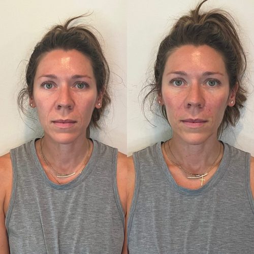 Filler-to-cheeks-and-nasolabial-folds-c1-1