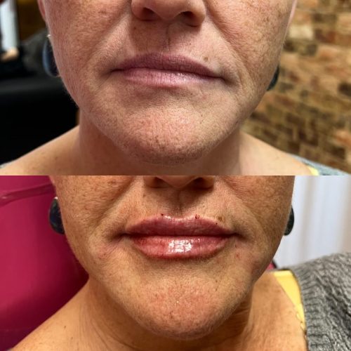 Lip-Filler-c1-1