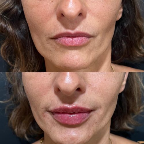 Lip-Filler-c2-1