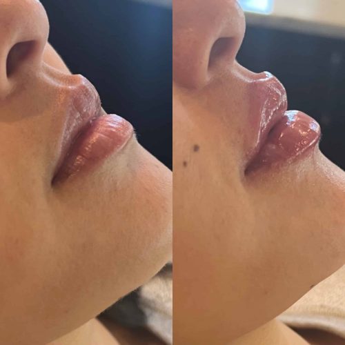 Lip-Filler-c3-1